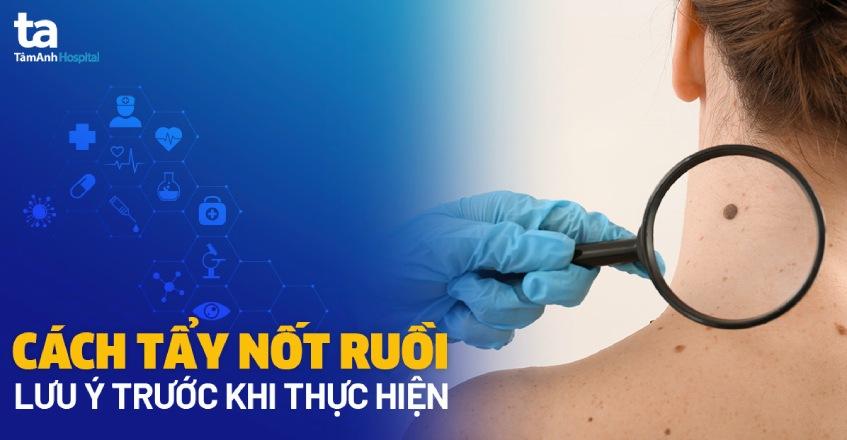 cách tẩy nốt ruồi