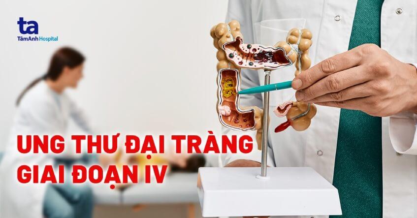 ung thư đại tràng giai đoạn 4