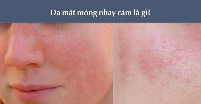 Da mặt mỏng nhạy cảm là gì?