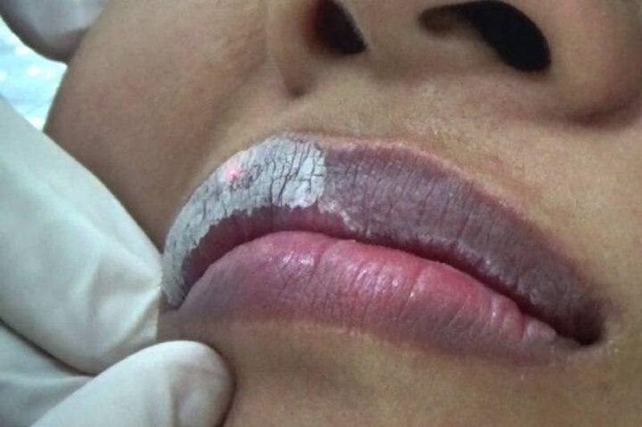 Khử thâm môi là thủ thuật thẩm mỹ được nhiều người quan tâm.