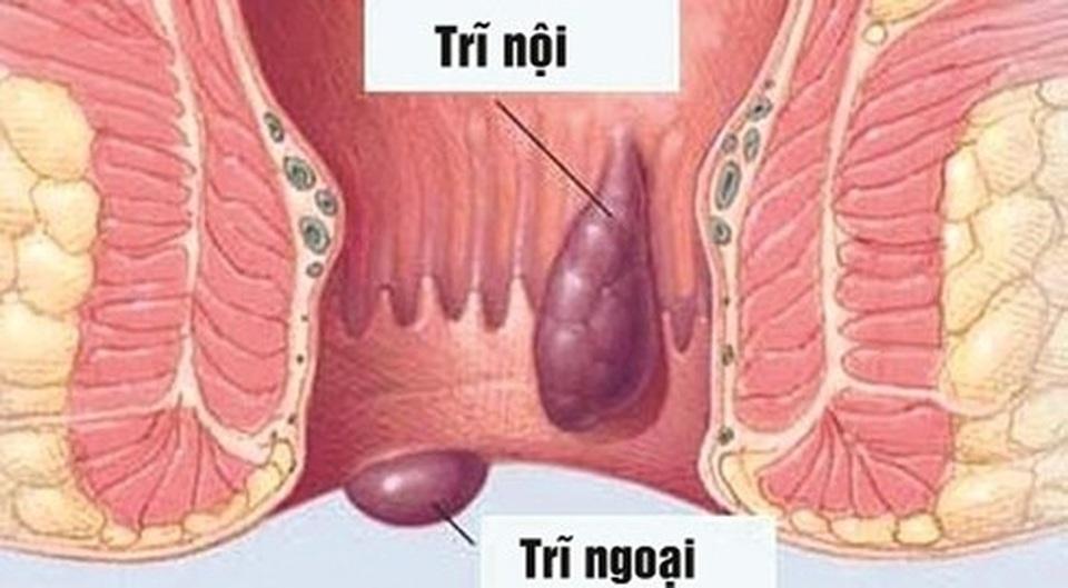 Bệnh trĩ điều trị như nào và công dụng của bộ sản phẩm Trĩ An Tâm - 1