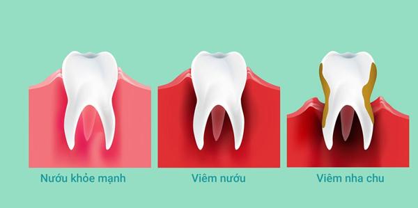 viêm nướu-viêm nha chu