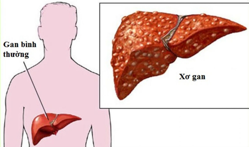 Xơ gan giai đoạn 2 có nguy hiểm không? 1