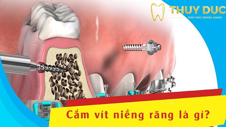 Cắm vít khi niềng răng là gì? 1