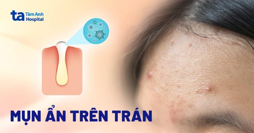 mụn ẩn trên trán