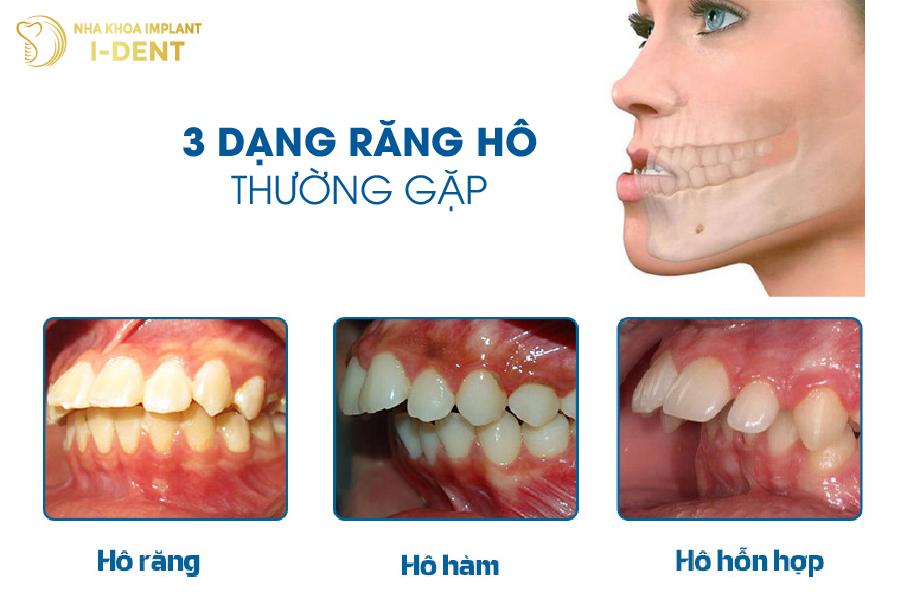 3 dạng răng hô thường gặp