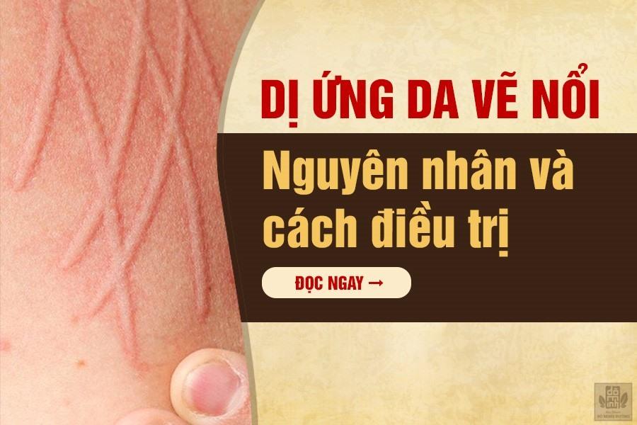 Dị ứng da vẽ nổi - nguyên nhân và cách điều trị hết mẩn ngứa