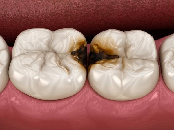 Sâu răng là bệnh lý răng miệng dễ gặp