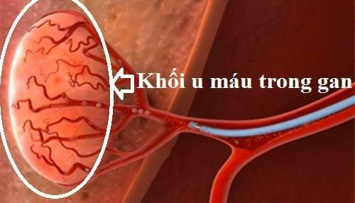 U máu trong gan là một khối u trong gan không ung thư (lành tính).